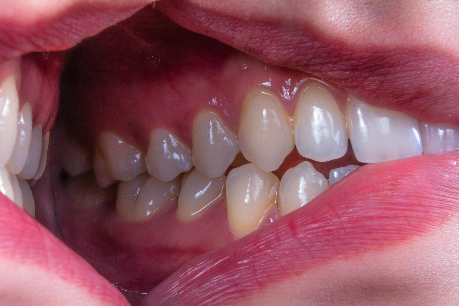 Is Gingivitis Infectious
